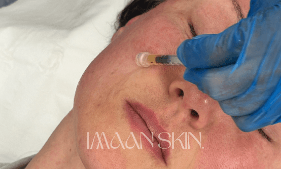 Close-up of a microneedling treatment in progress at Imaan Skin, Moseley